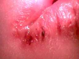 Befallene Lippen, 10 fach vergr��ert. Bildquelle: www.morgellons.org#Morgellons2.htm